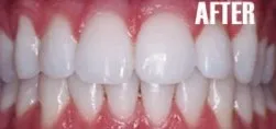 after in office teeth whitening