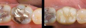 Before and after tooth composite