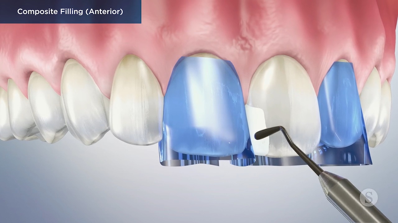 Composite Filling Video Thumbnail