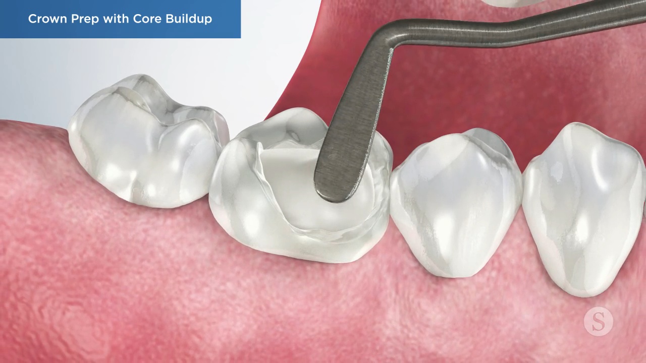 Crown Prep with Core Buildup Video Thumbnail