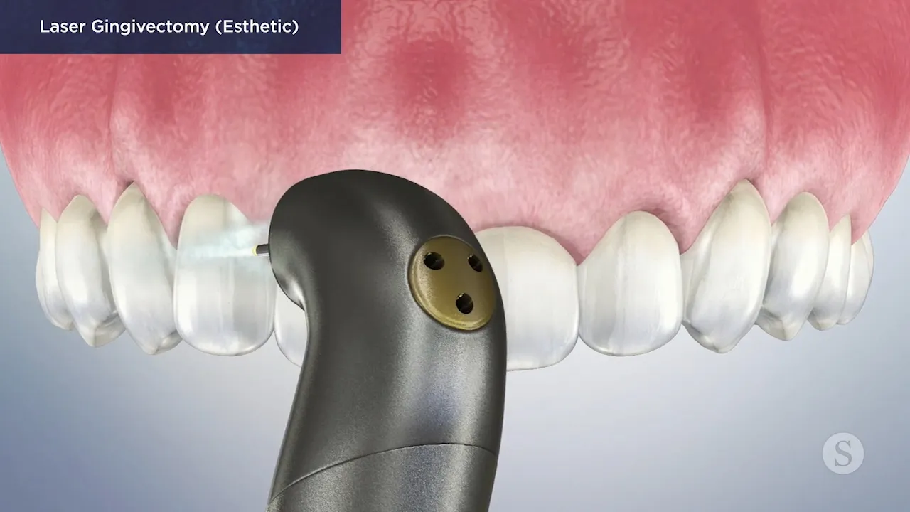 Laser Gingivectomy Video Thumbnail
